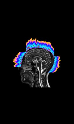 Cranial signal map — measured readout mapped to head and brain anatomy